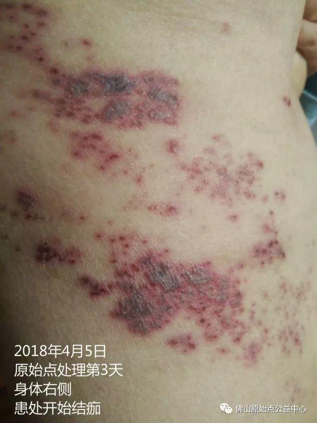 原始点调理带状疱疹:12天恢复 意外收获