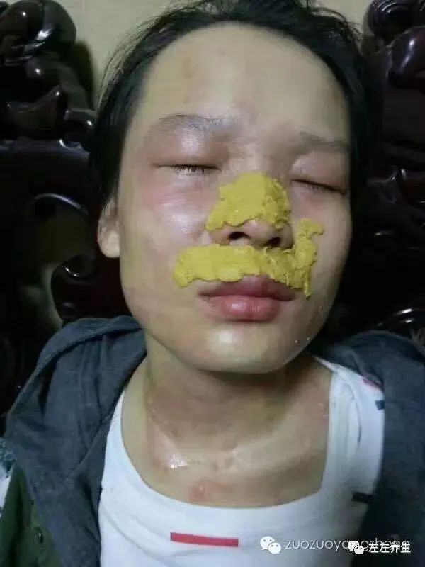 案例分享：花季少女面部烫伤不留疤的调理案例