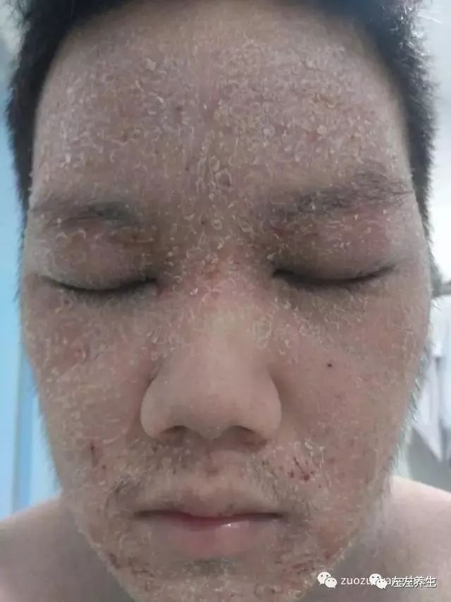 案例分享:马来西亚男孩严重湿疹、十天后大变样 案例分享:马来西亚男孩严重湿疹、十天后大变样