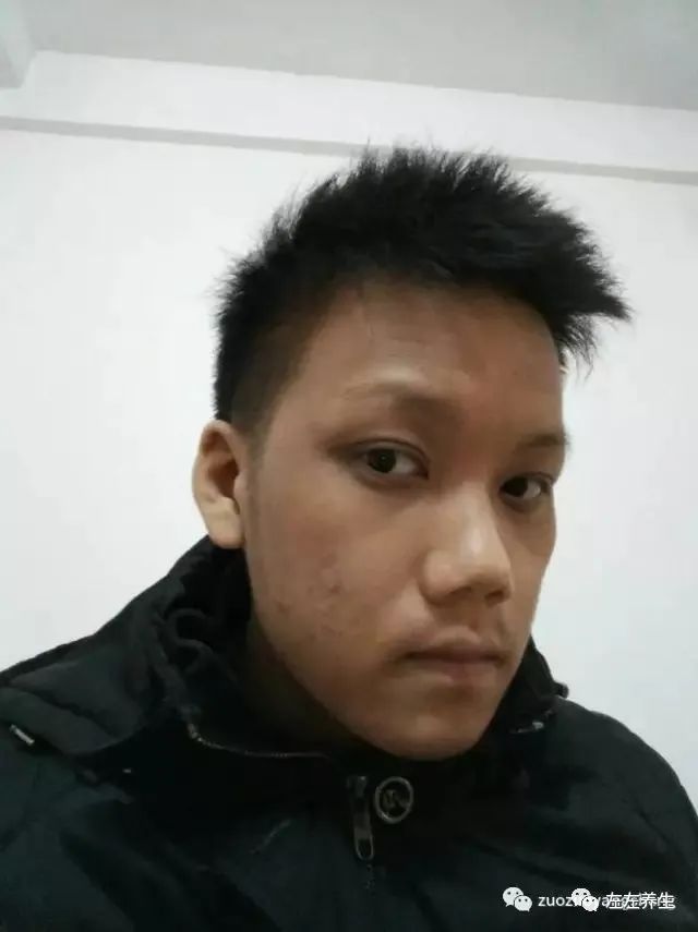 案例分享:马来西亚男孩严重湿疹、十天后大变样 案例分享:马来西亚男孩严重湿疹、十天后大变样