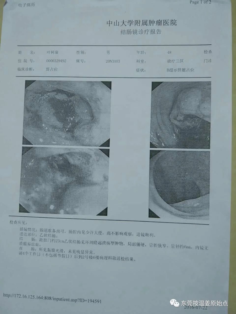 结肠癌、肝转移、肺转移